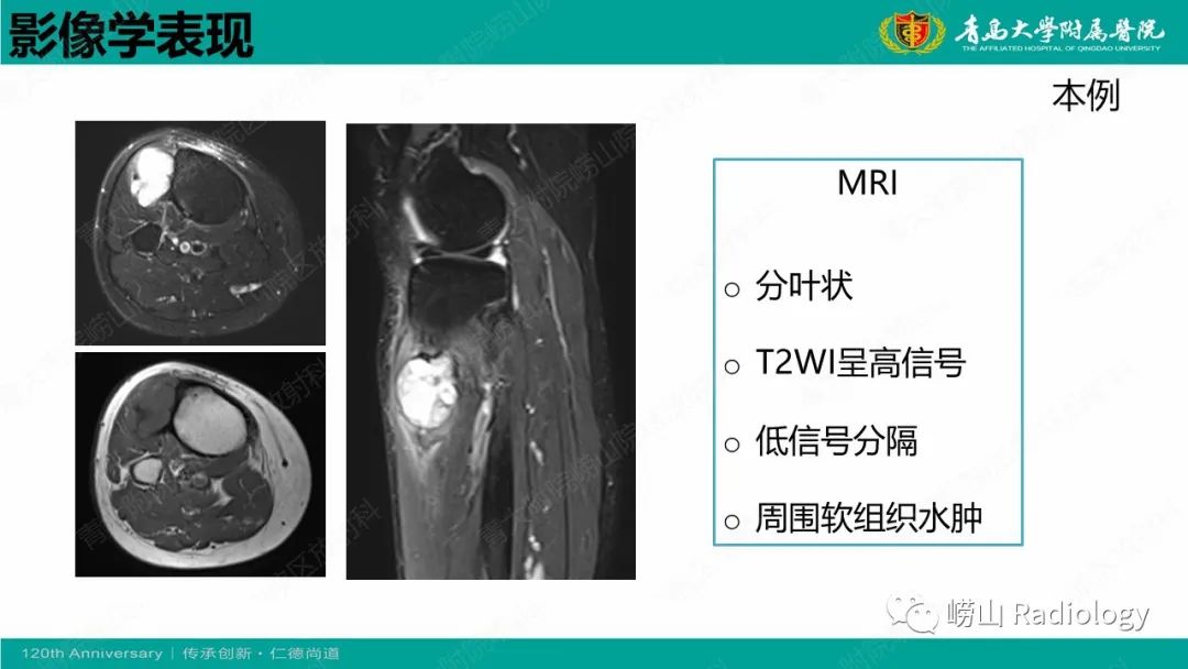 影像PPT - 【病例】胫骨骨膜软骨肉瘤1例CT及MR-18