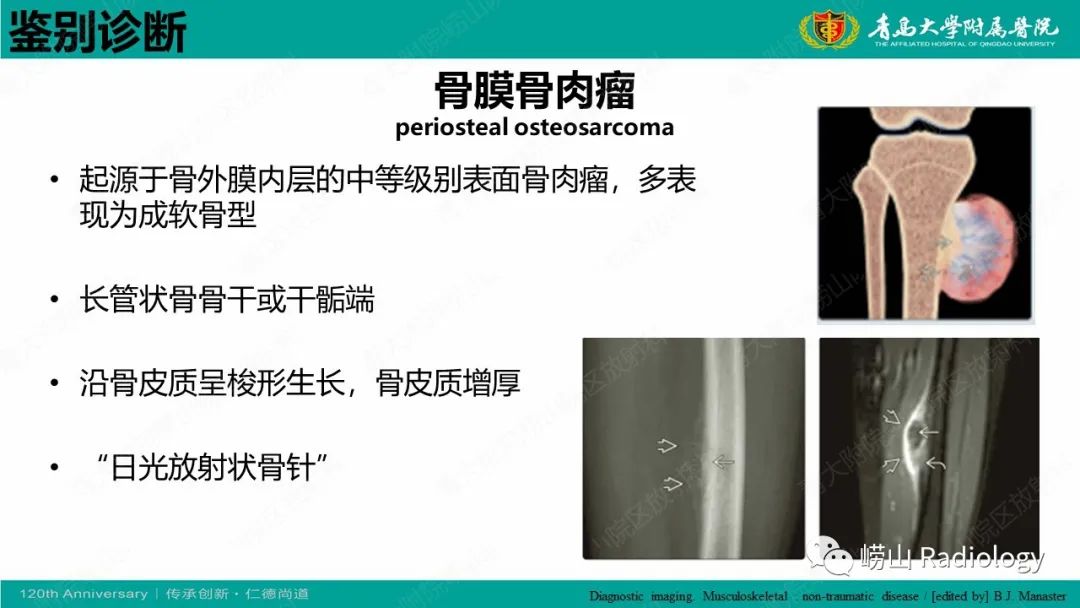 影像PPT - 【病例】胫骨骨膜软骨肉瘤1例CT及MR-21