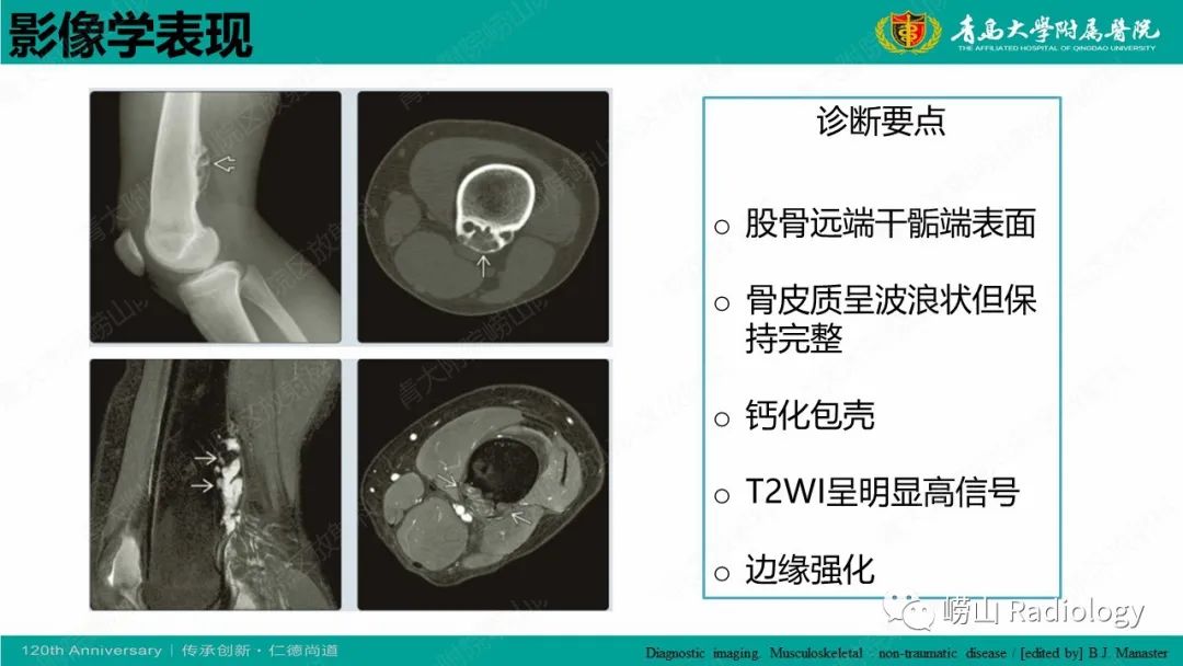 影像PPT - 【病例】胫骨骨膜软骨肉瘤1例CT及MR-19