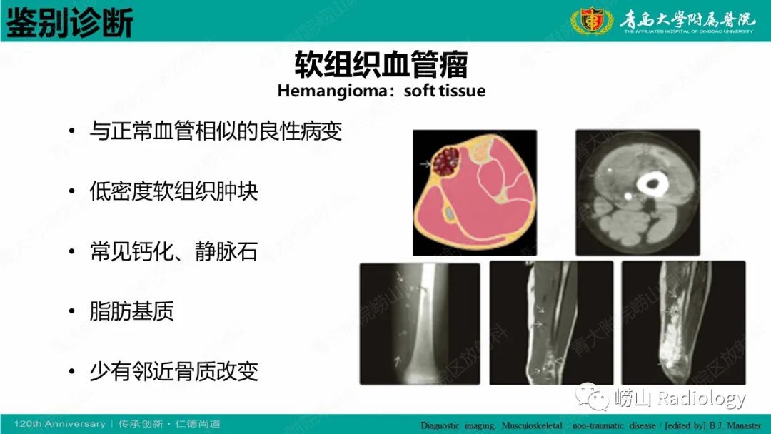 影像PPT - 【病例】胫骨骨膜软骨肉瘤1例CT及MR-22