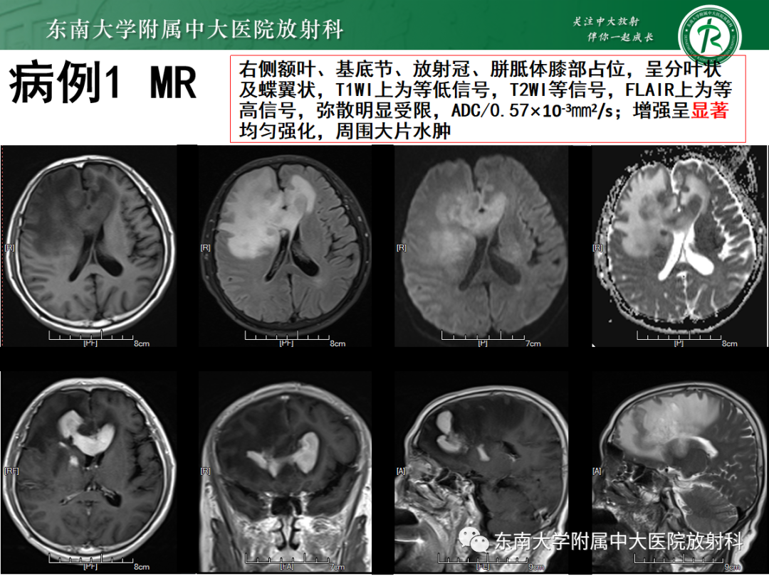 影像PPT - 【PPT】原发性中枢神经系统淋巴瘤的影像学表现-2
