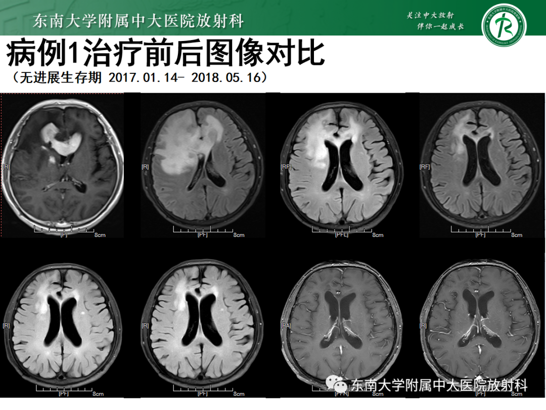影像PPT - 【PPT】原发性中枢神经系统淋巴瘤的影像学表现-4