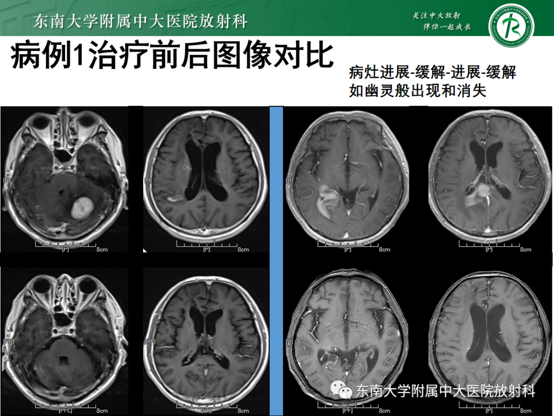 影像PPT - 【PPT】原发性中枢神经系统淋巴瘤的影像学表现-5