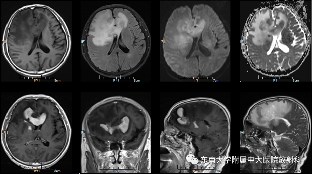 影像PPT - 【PPT】原发性中枢神经系统淋巴瘤的影像学表现-1