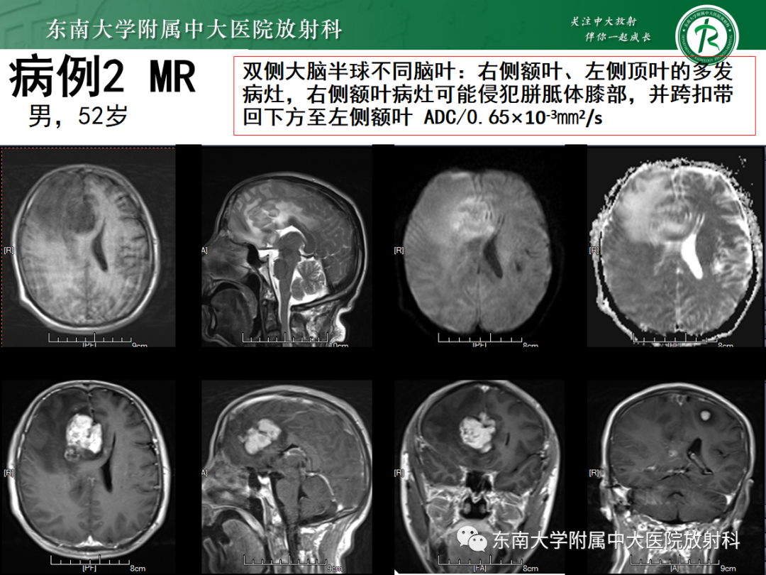 影像PPT - 【PPT】原发性中枢神经系统淋巴瘤的影像学表现-19