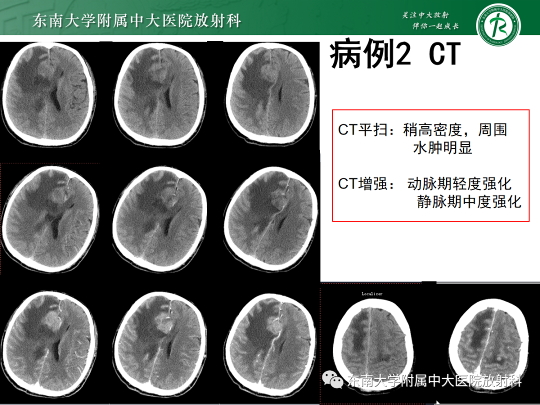 影像PPT - 【PPT】原发性中枢神经系统淋巴瘤的影像学表现-20