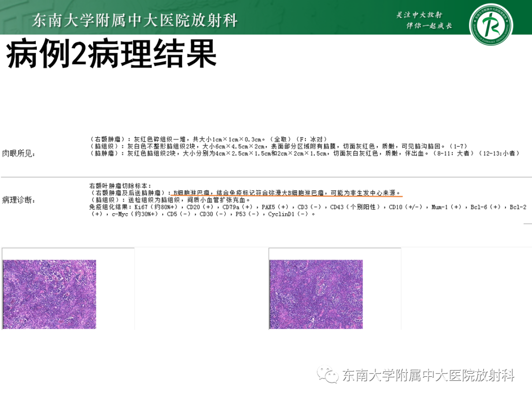 影像PPT - 【PPT】原发性中枢神经系统淋巴瘤的影像学表现-21