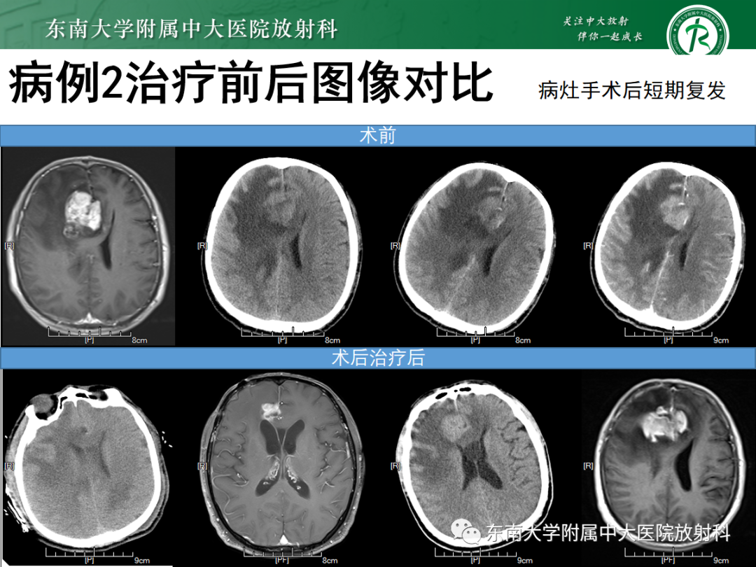 影像PPT - 【PPT】原发性中枢神经系统淋巴瘤的影像学表现-22