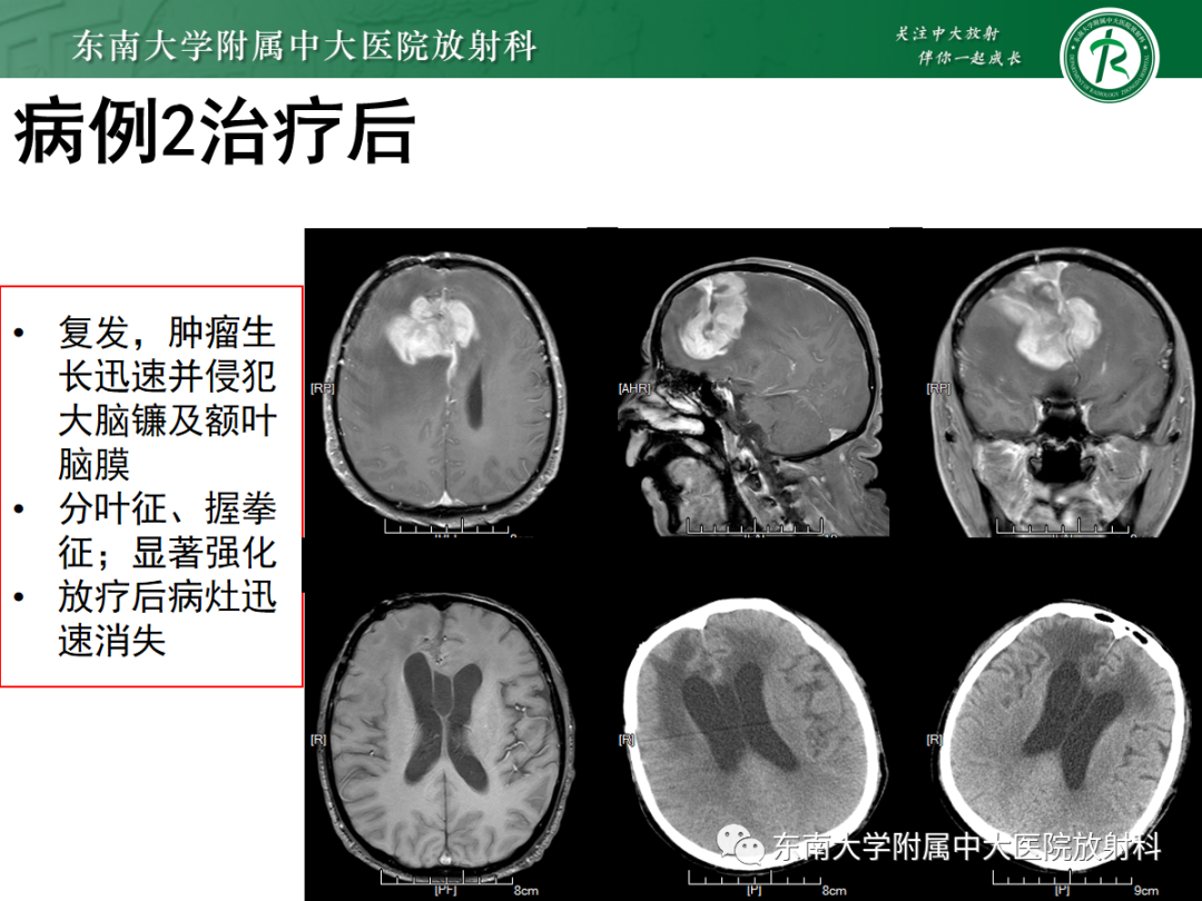 影像PPT - 【PPT】原发性中枢神经系统淋巴瘤的影像学表现-23