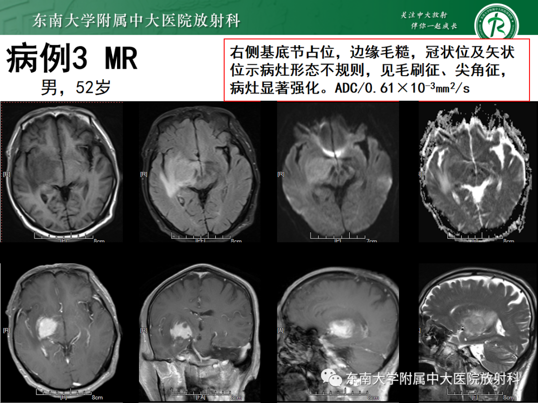 影像PPT - 【PPT】原发性中枢神经系统淋巴瘤的影像学表现-24