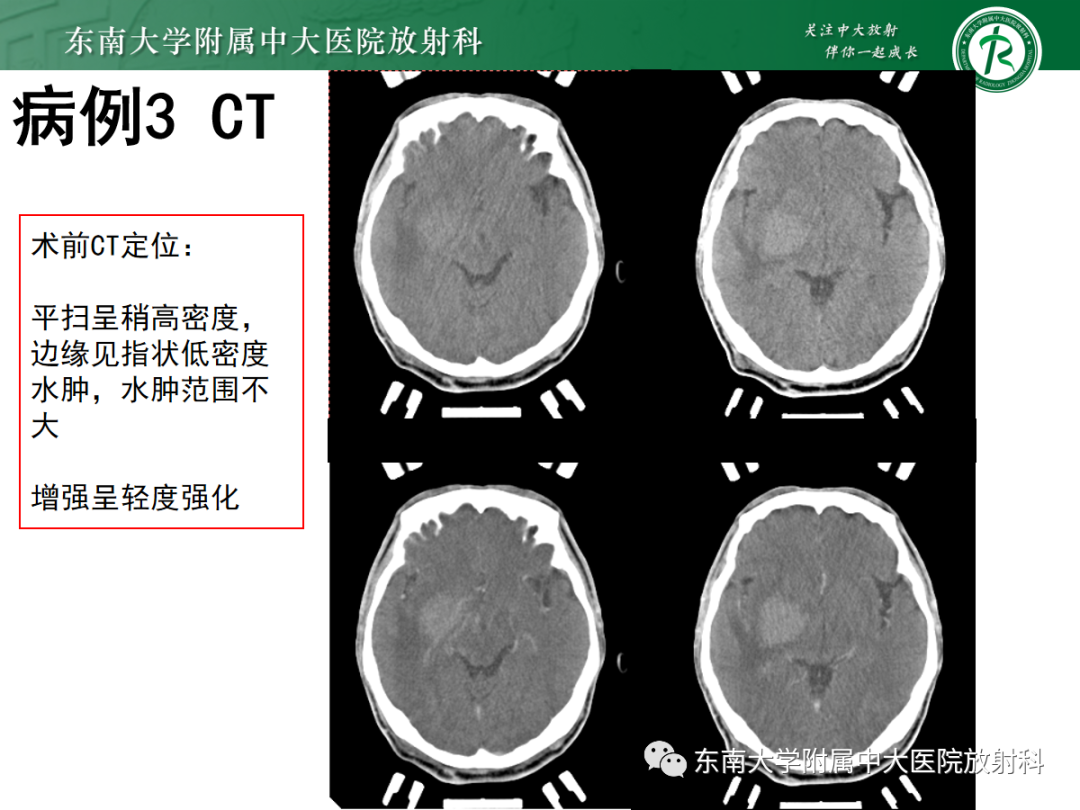 影像PPT - 【PPT】原发性中枢神经系统淋巴瘤的影像学表现-25