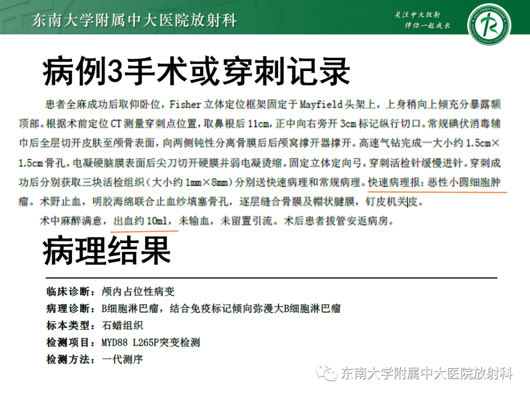 影像PPT - 【PPT】原发性中枢神经系统淋巴瘤的影像学表现-26