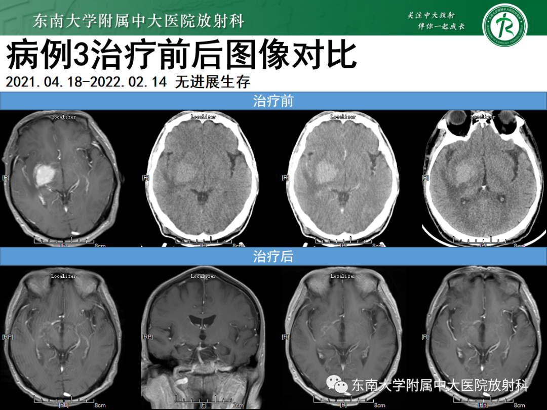 影像PPT - 【PPT】原发性中枢神经系统淋巴瘤的影像学表现-27