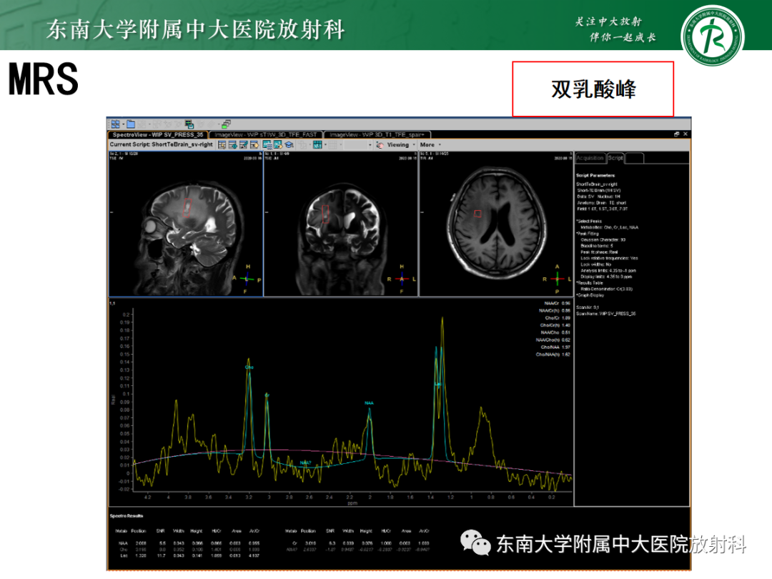 影像PPT - 【PPT】原发性中枢神经系统淋巴瘤的影像学表现-29