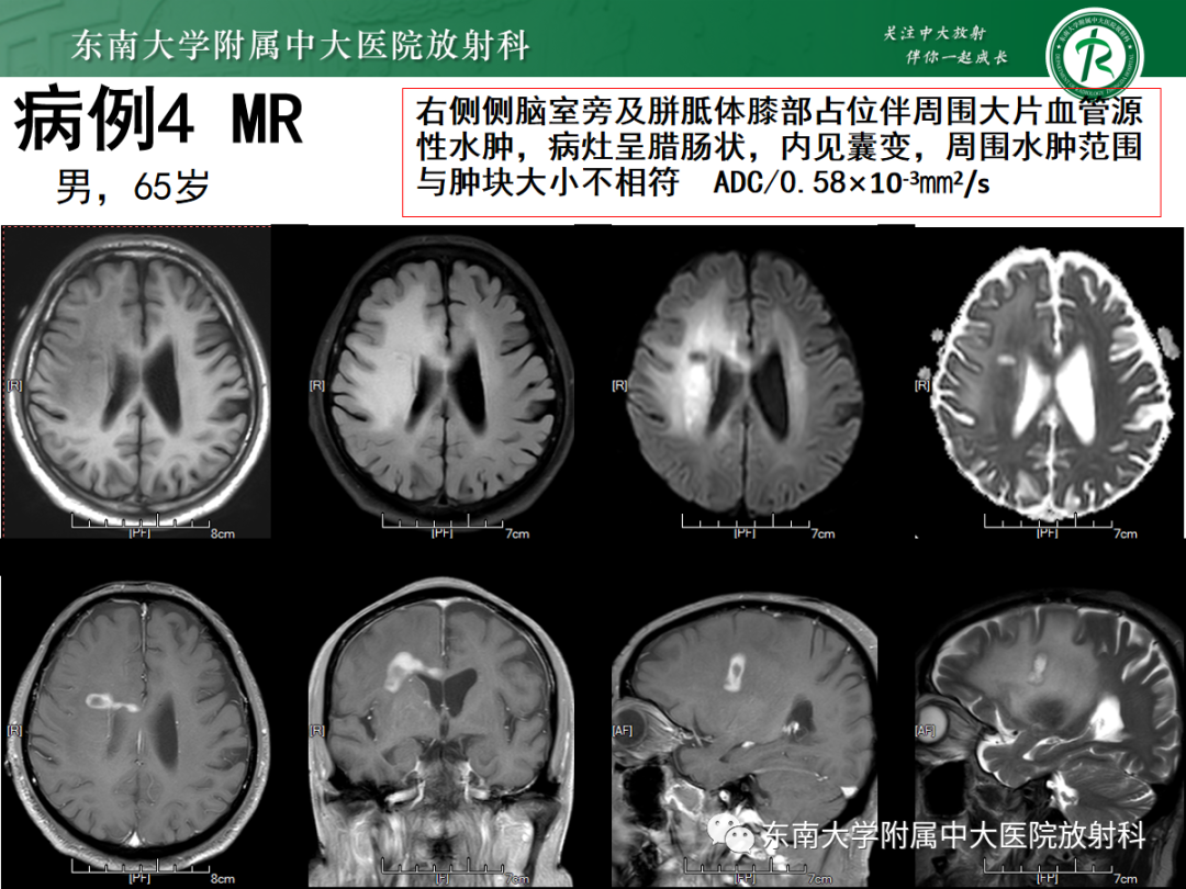 影像PPT - 【PPT】原发性中枢神经系统淋巴瘤的影像学表现-28
