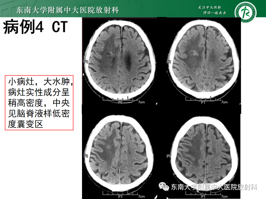 影像PPT - 【PPT】原发性中枢神经系统淋巴瘤的影像学表现-30
