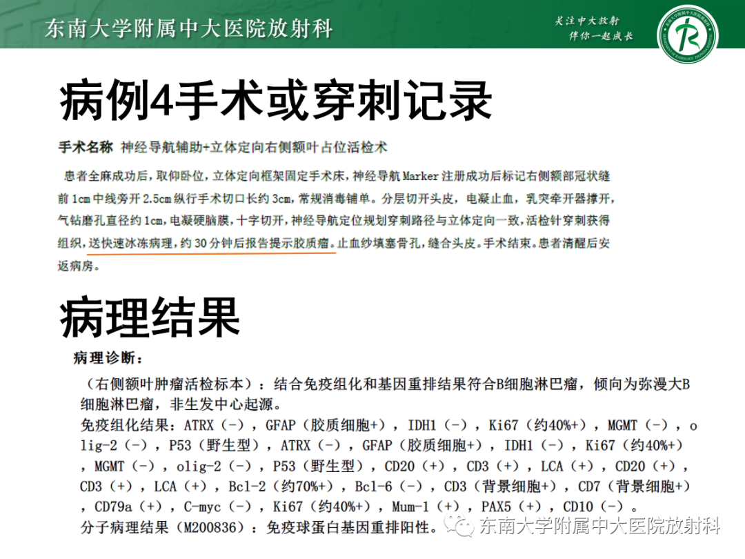 影像PPT - 【PPT】原发性中枢神经系统淋巴瘤的影像学表现-31