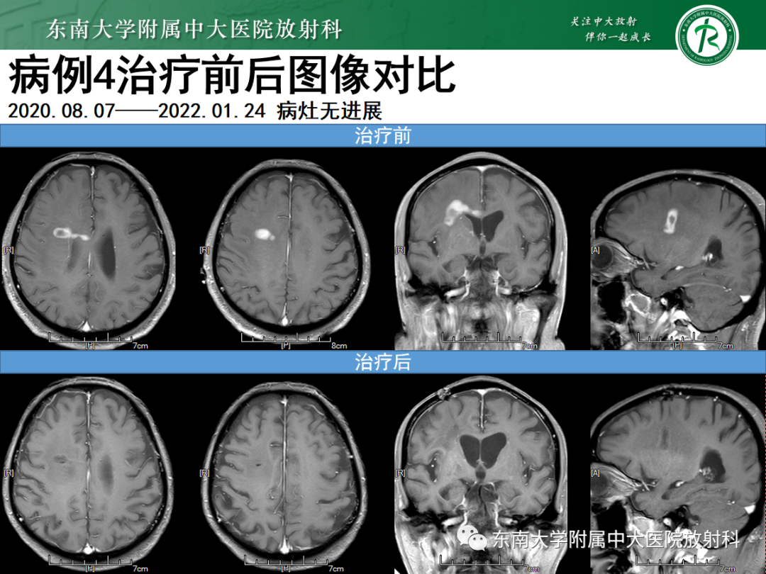 影像PPT - 【PPT】原发性中枢神经系统淋巴瘤的影像学表现-32