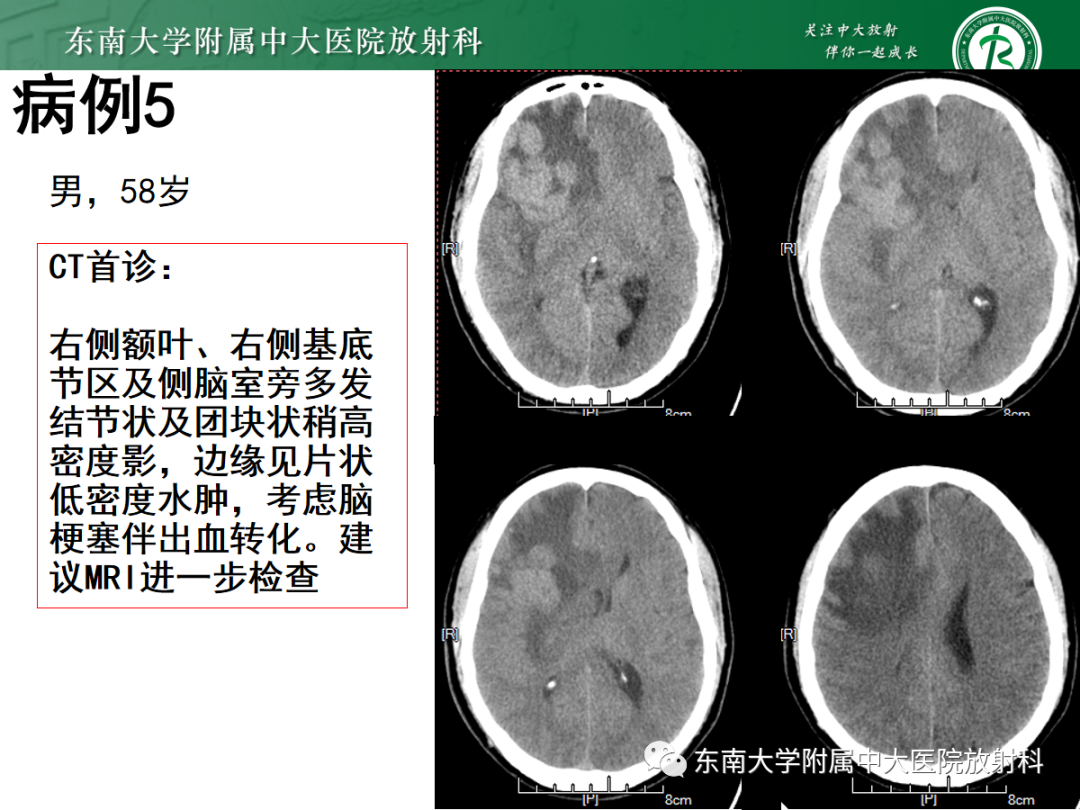 影像PPT - 【PPT】原发性中枢神经系统淋巴瘤的影像学表现-33
