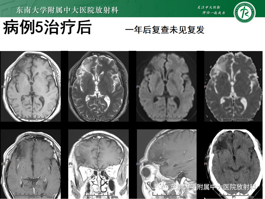 影像PPT - 【PPT】原发性中枢神经系统淋巴瘤的影像学表现-35