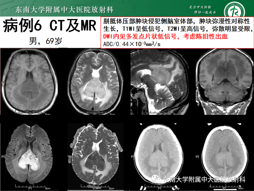 影像PPT - 【PPT】原发性中枢神经系统淋巴瘤的影像学表现-36