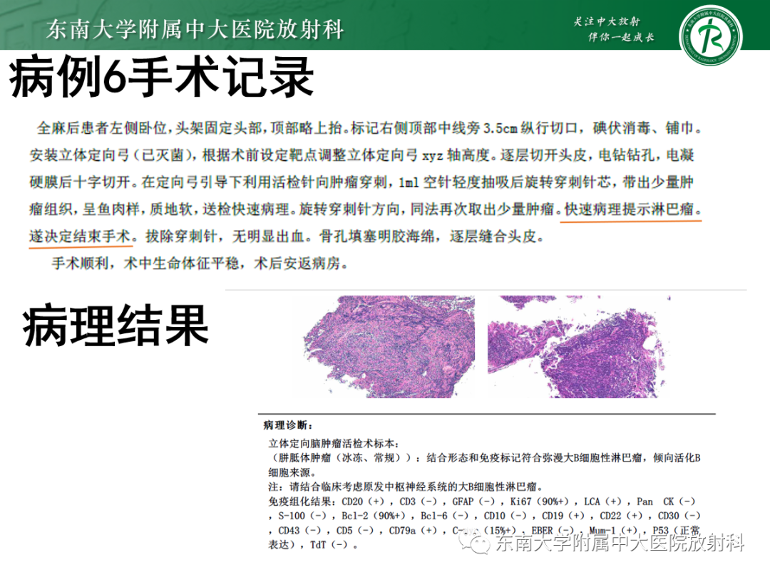 影像PPT - 【PPT】原发性中枢神经系统淋巴瘤的影像学表现-37