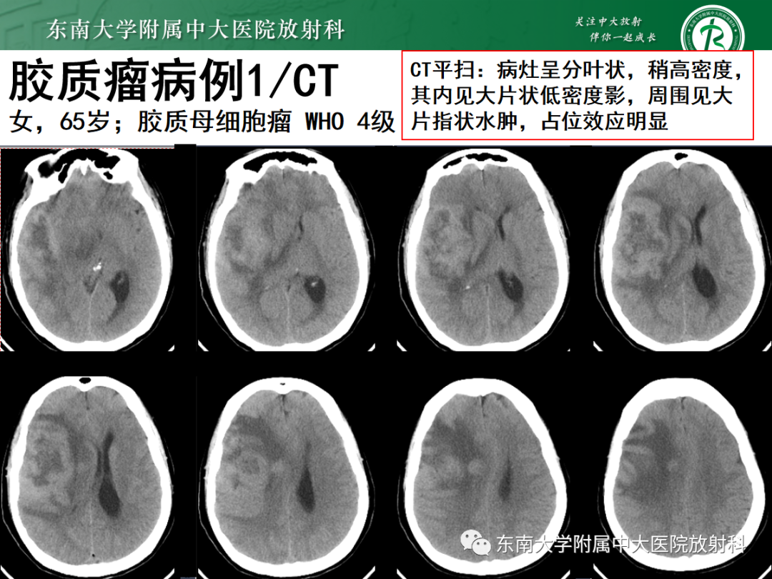 影像PPT - 【PPT】原发性中枢神经系统淋巴瘤的影像学表现-42