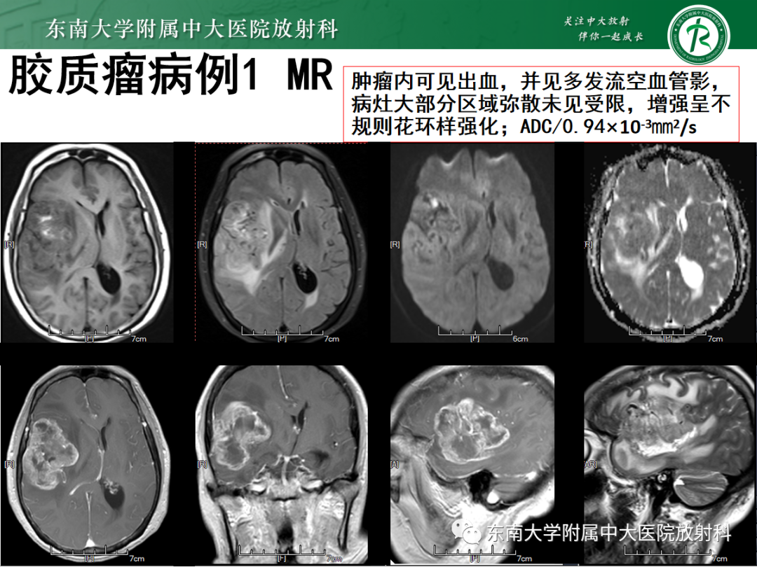 影像PPT - 【PPT】原发性中枢神经系统淋巴瘤的影像学表现-43