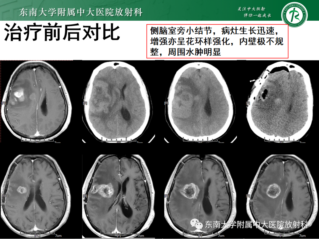 影像PPT - 【PPT】原发性中枢神经系统淋巴瘤的影像学表现-44