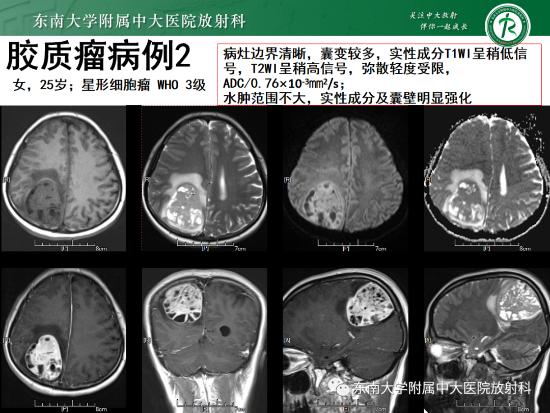 影像PPT - 【PPT】原发性中枢神经系统淋巴瘤的影像学表现-45