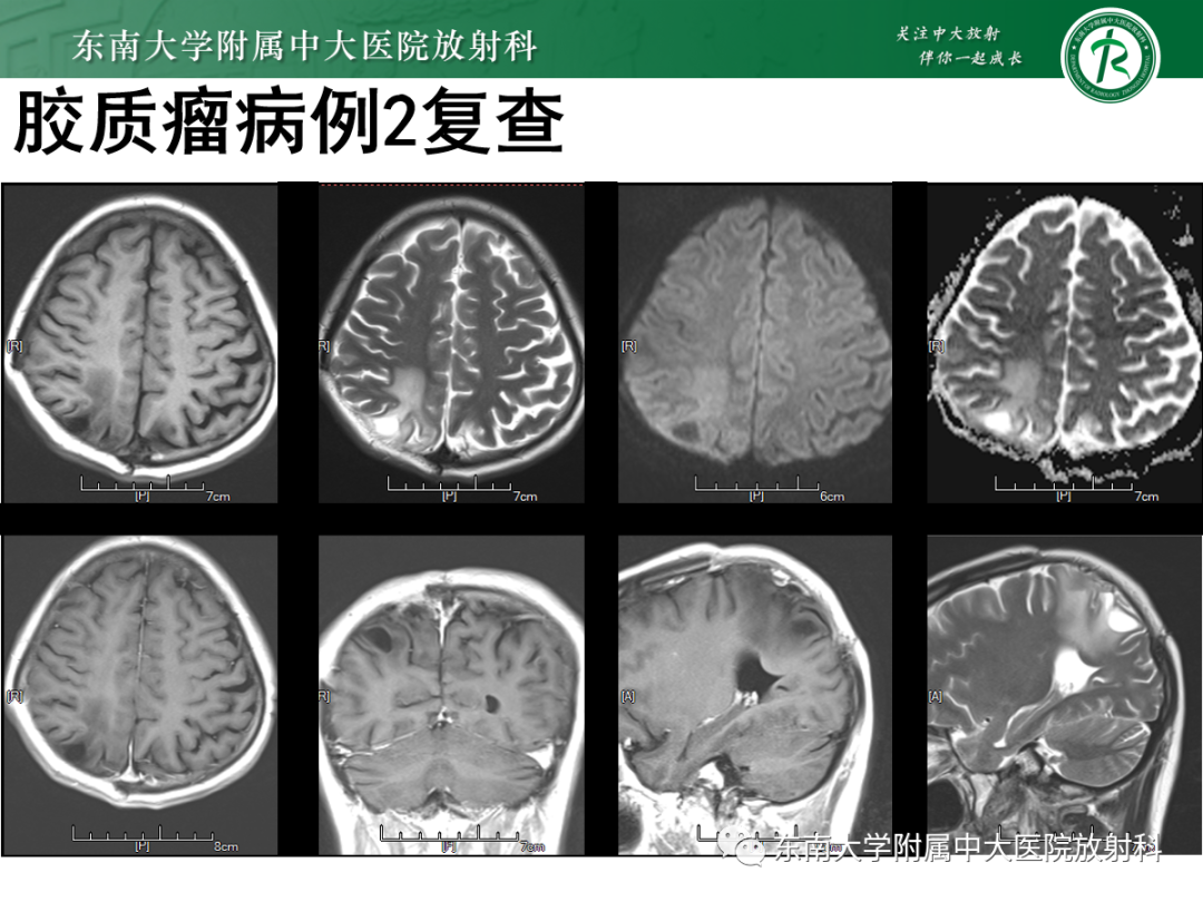 影像PPT - 【PPT】原发性中枢神经系统淋巴瘤的影像学表现-46
