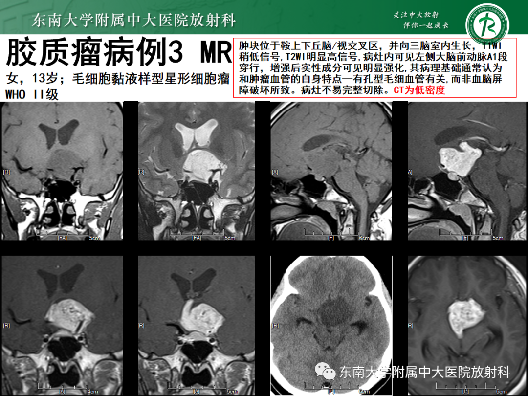 影像PPT - 【PPT】原发性中枢神经系统淋巴瘤的影像学表现-47