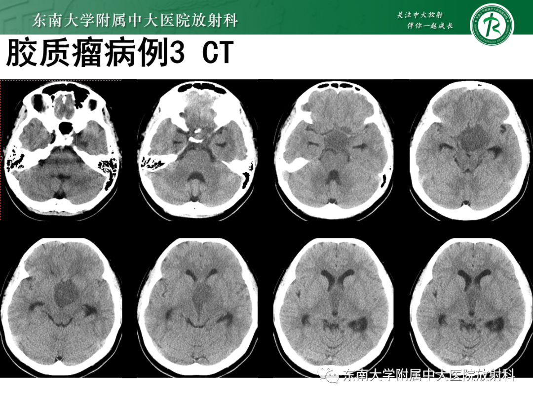 影像PPT - 【PPT】原发性中枢神经系统淋巴瘤的影像学表现-48