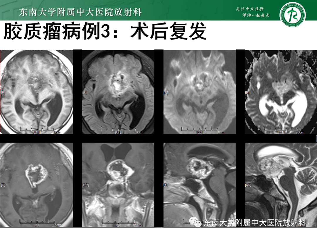 影像PPT - 【PPT】原发性中枢神经系统淋巴瘤的影像学表现-49