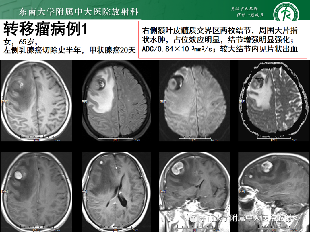 影像PPT - 【PPT】原发性中枢神经系统淋巴瘤的影像学表现-52