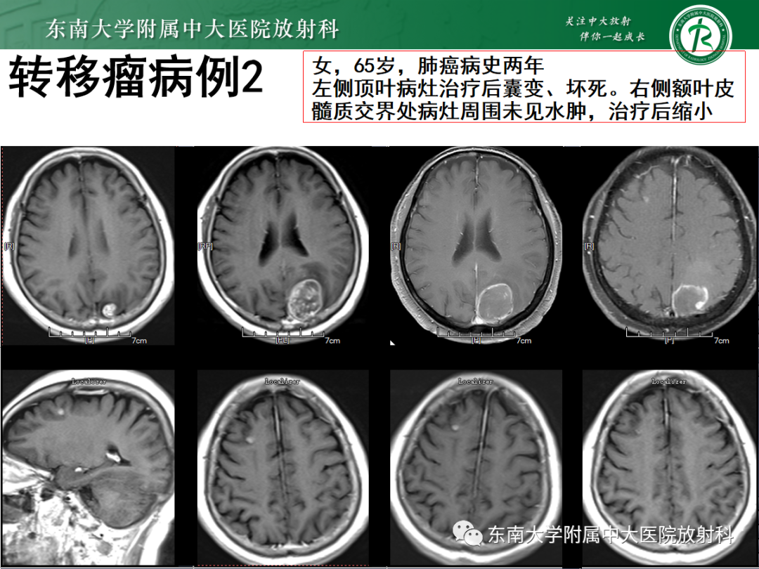 影像PPT - 【PPT】原发性中枢神经系统淋巴瘤的影像学表现-53