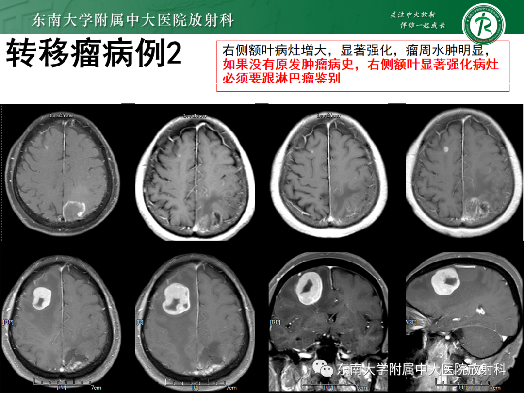 影像PPT - 【PPT】原发性中枢神经系统淋巴瘤的影像学表现-54