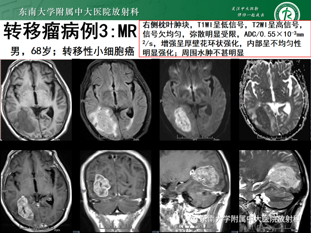 影像PPT - 【PPT】原发性中枢神经系统淋巴瘤的影像学表现-55