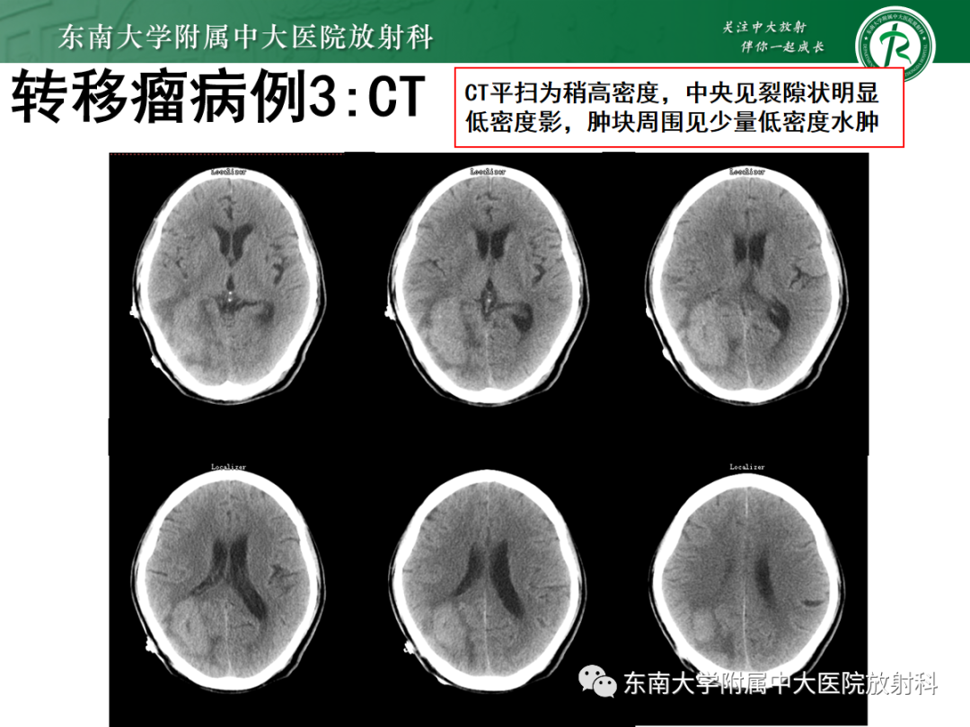 影像PPT - 【PPT】原发性中枢神经系统淋巴瘤的影像学表现-56