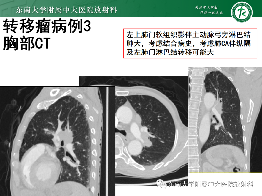 影像PPT - 【PPT】原发性中枢神经系统淋巴瘤的影像学表现-57