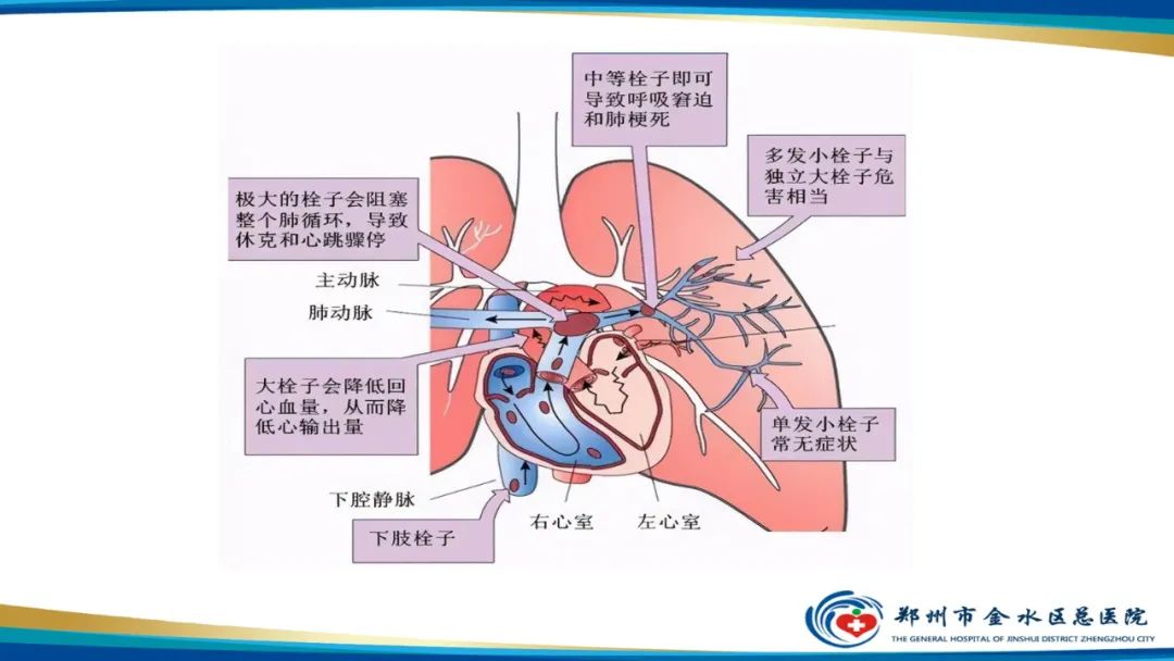 影像PPT - 【PPT】肺动脉CTA扫描技术-18
