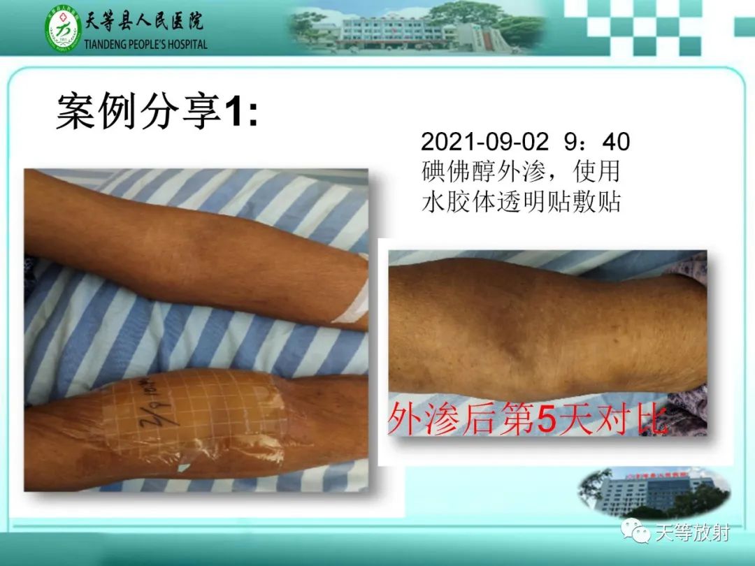 影像PPT - 【PPT】碘造影剂外渗的预防及处理-18