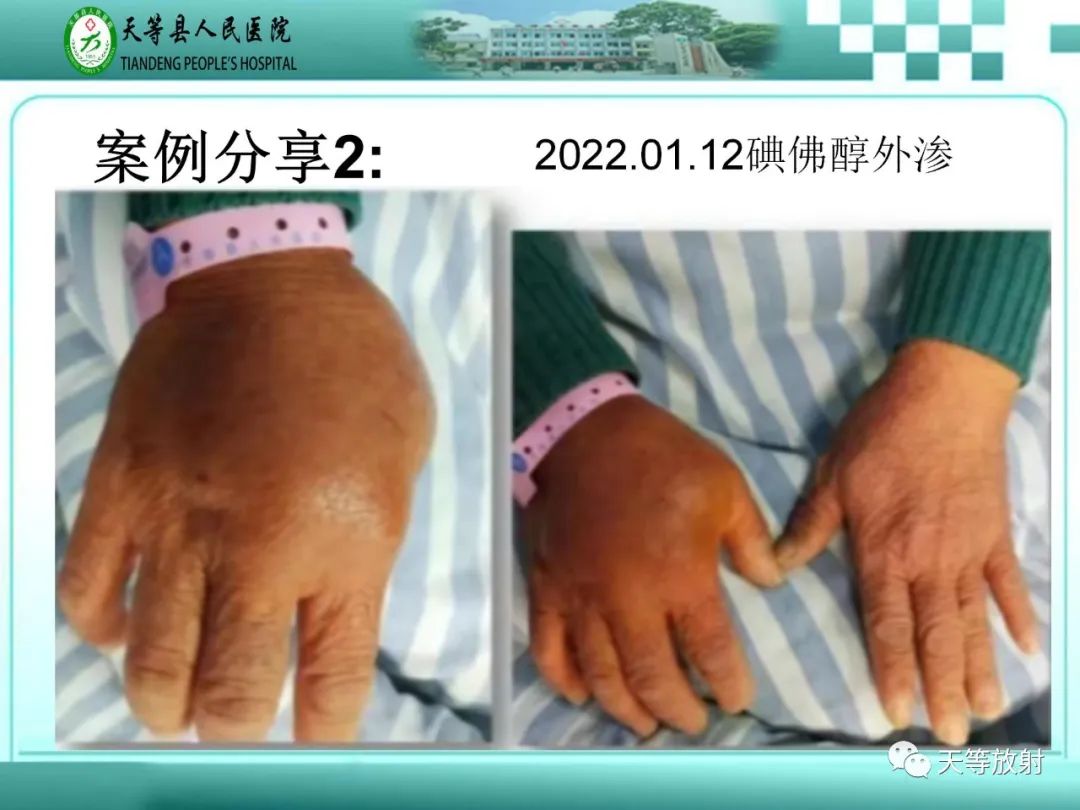 影像PPT - 【PPT】碘造影剂外渗的预防及处理-19