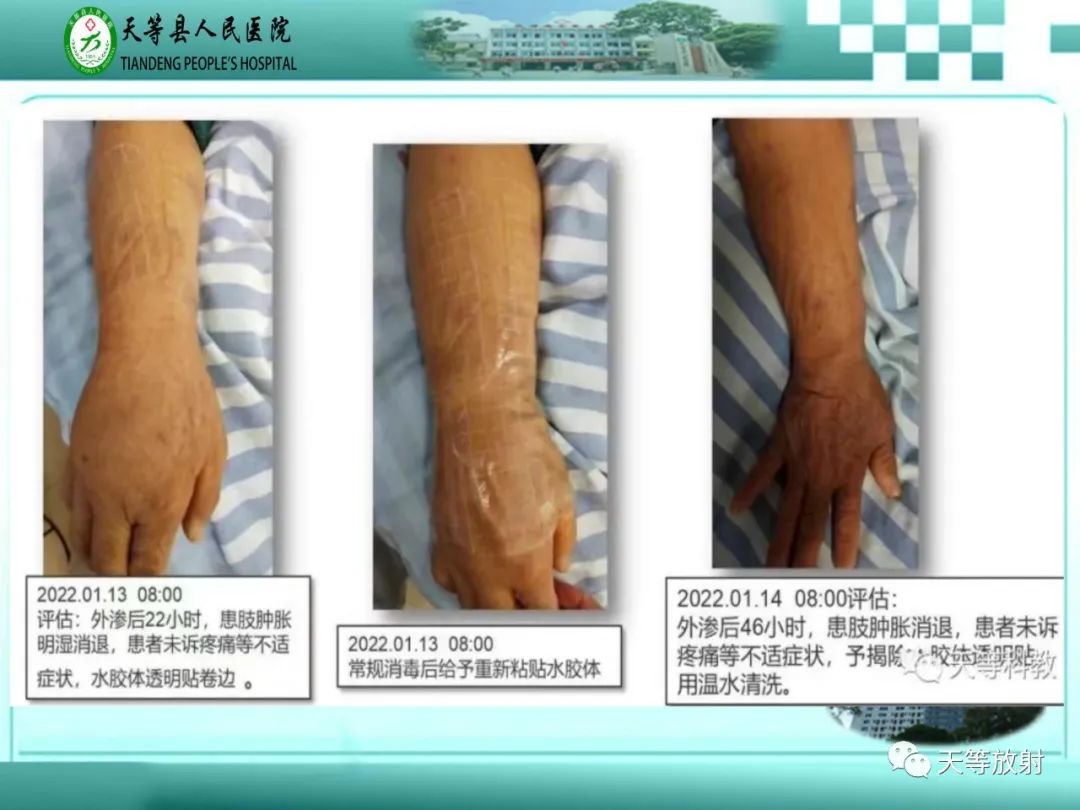 影像PPT - 【PPT】碘造影剂外渗的预防及处理-21