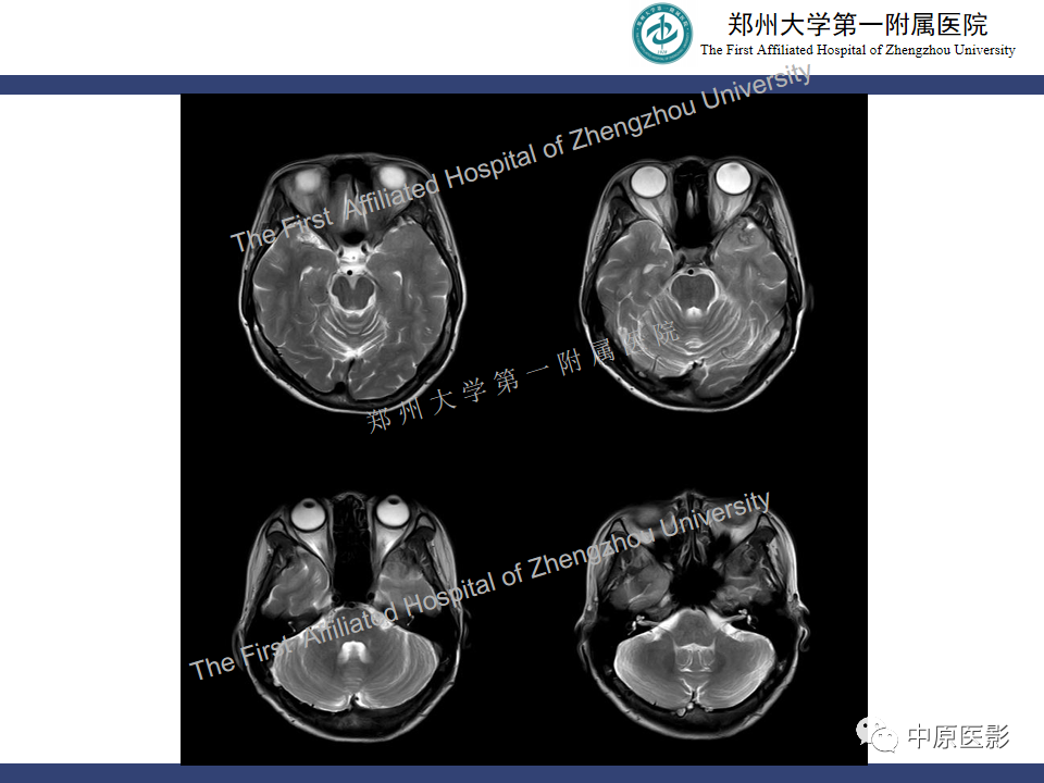 影像PPT - 【病例】颅内软骨肉瘤1例MR影像-3