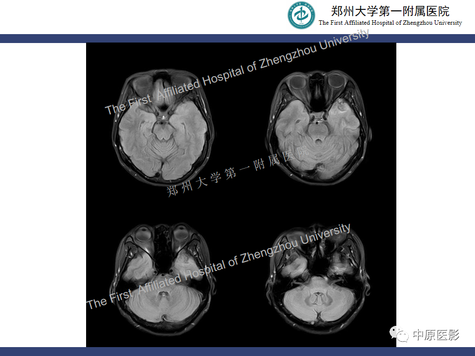 影像PPT - 【病例】颅内软骨肉瘤1例MR影像-5