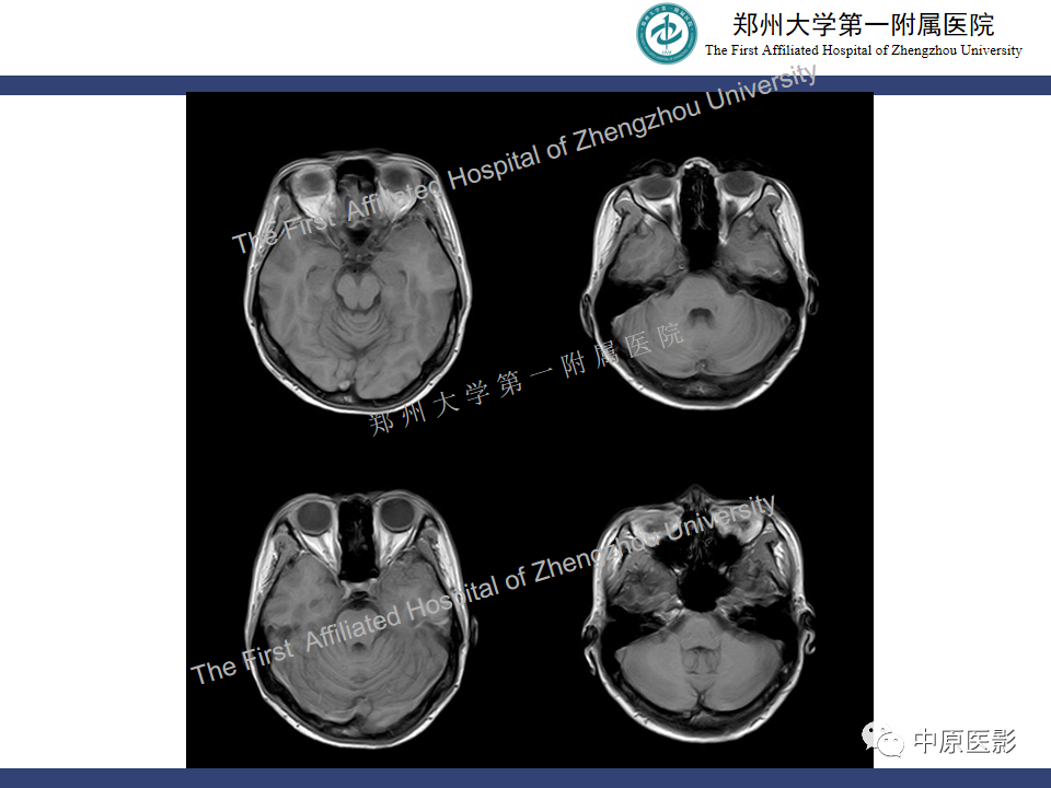 影像PPT - 【病例】颅内软骨肉瘤1例MR影像-4