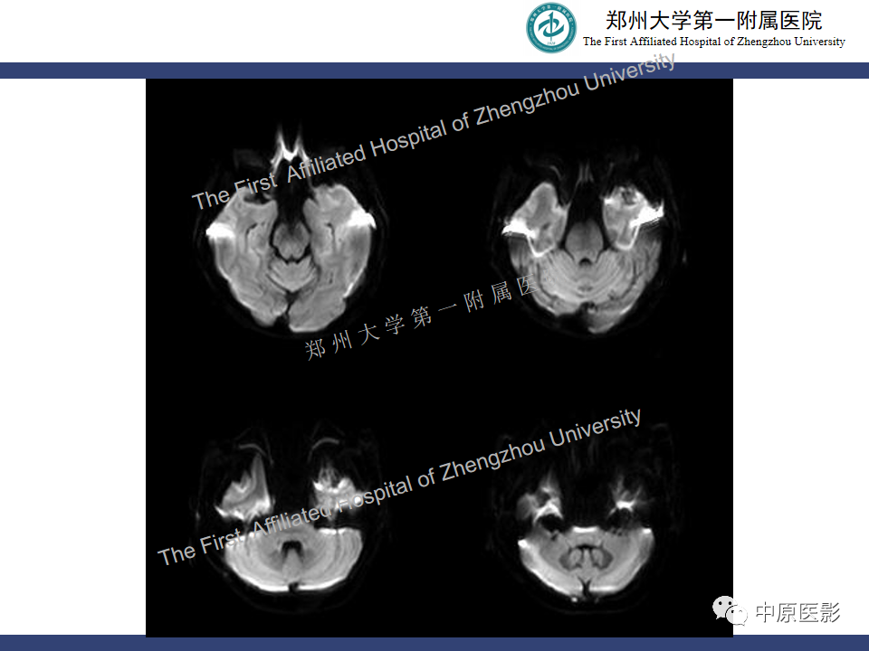 影像PPT - 【病例】颅内软骨肉瘤1例MR影像-6