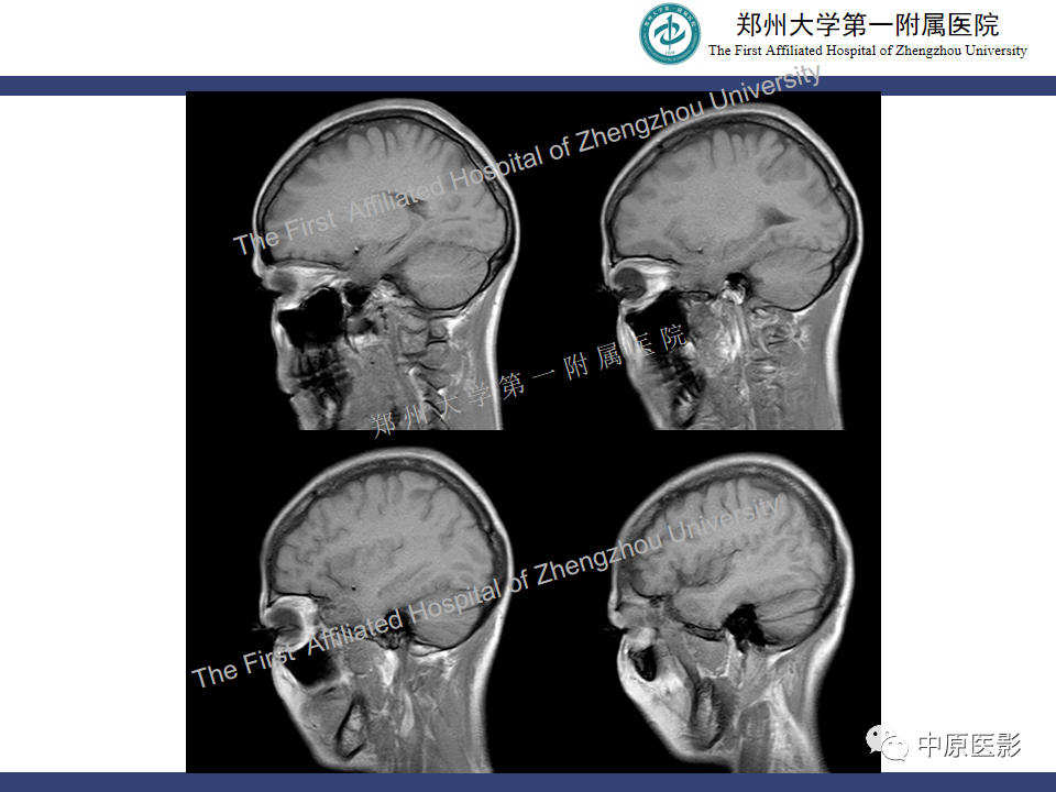 影像PPT - 【病例】颅内软骨肉瘤1例MR影像-7