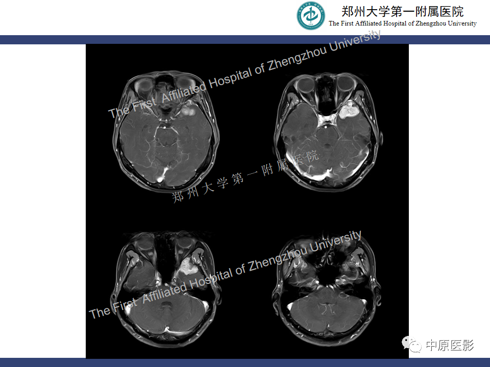 影像PPT - 【病例】颅内软骨肉瘤1例MR影像-8